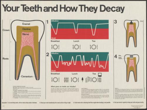 Your teeth and how they decay [picture] : what goes on inside our mouths?